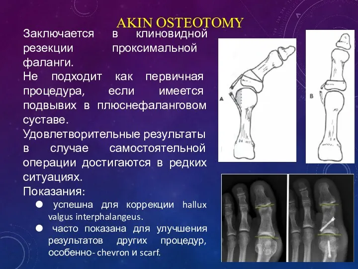 AKIN OSTEOTOMY Заключается в клиновидной резекции проксимальной фаланги. Не подходит