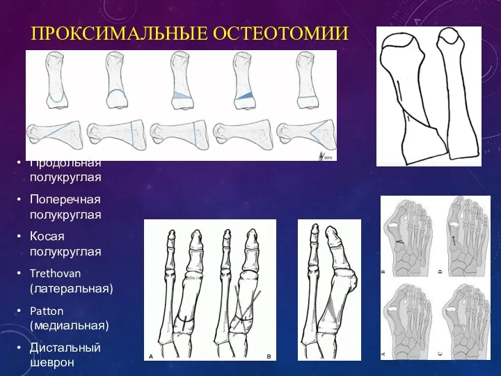 ПРОКСИМАЛЬНЫЕ ОСТЕОТОМИИ Продольная полукруглая Поперечная полукруглая Косая полукруглая Trethovan (латеральная) Patton (медиальная) Дистальный шеврон