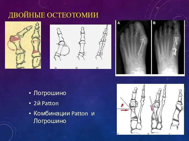 ДВОЙНЫЕ ОСТЕОТОМИИ Логрошино 2й Patton Комбинации Patton и Логрошино