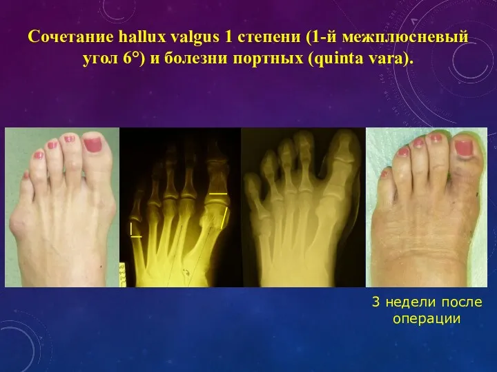 Сочетание hallux valgus 1 степени (1-й межплюсневый угол 6°) и