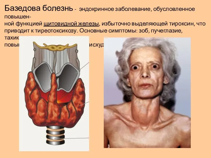 Базедова болезнь - эндокринное заболевание, обусловленное повышен- ной функцией щитовидной