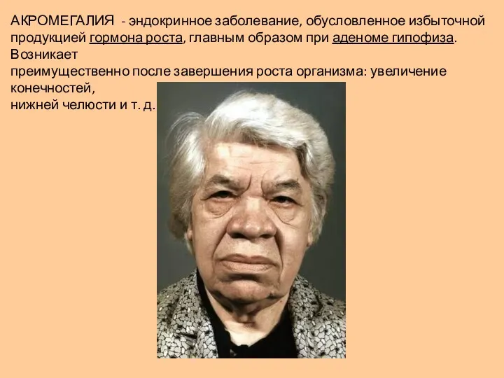 АКРОМЕГАЛИЯ - эндокринное заболевание, обусловленное избыточной продукцией гормона роста, главным