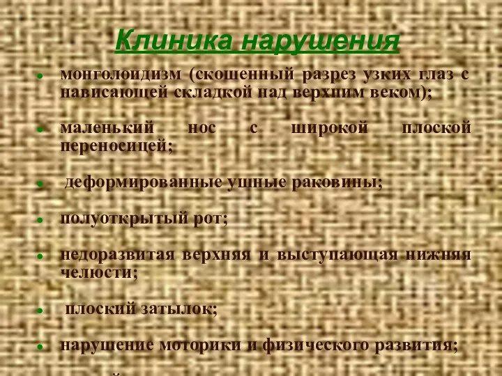 Клиника нарушения монголоидизм (скошенный разрез узких глаз с нависающей складкой