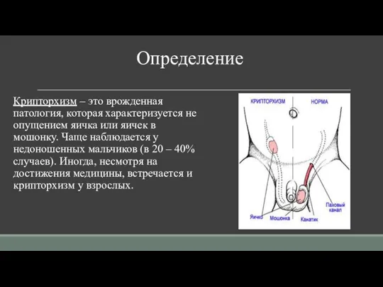 Определение Крипторхизм – это врожденная патология, которая характеризуется не опущением