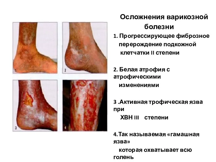Осложнения варикозной болезни 1. Прогрессирующее фиброзное перерождение подкожной клетчатки II