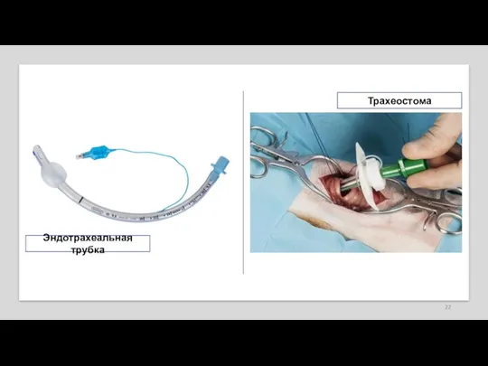 Эндотрахеальная трубка Трахеостома