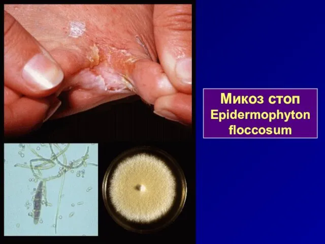 Микоз стоп Epidermophyton floccosum