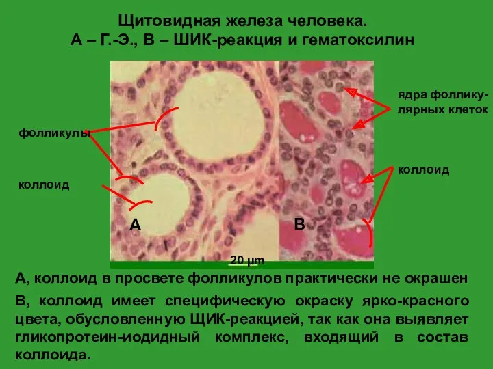 B, коллоид имеет специфическую окраску ярко-красного цвета, обусловленную ЩИК-реакцией, так как она выявляет