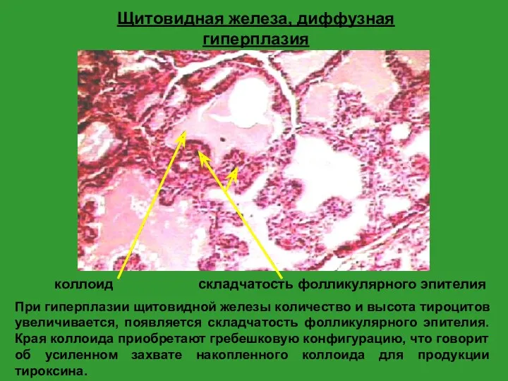 Щитовидная железа, диффузная гиперплазия При гиперплазии щитовидной железы количество и