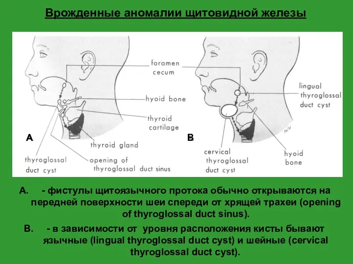 Врожденные аномалии щитовидной железы
