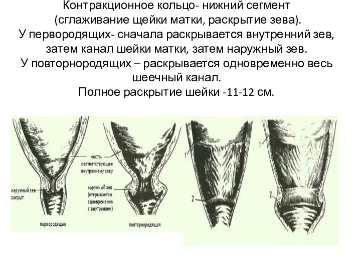 Контракционное кольцо- нижний сегмент (сглаживание щейки матки, раскрытие зева). У