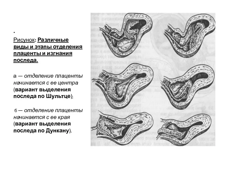. Рисунок: Различные виды и этапы отделения плаценты и изгнания