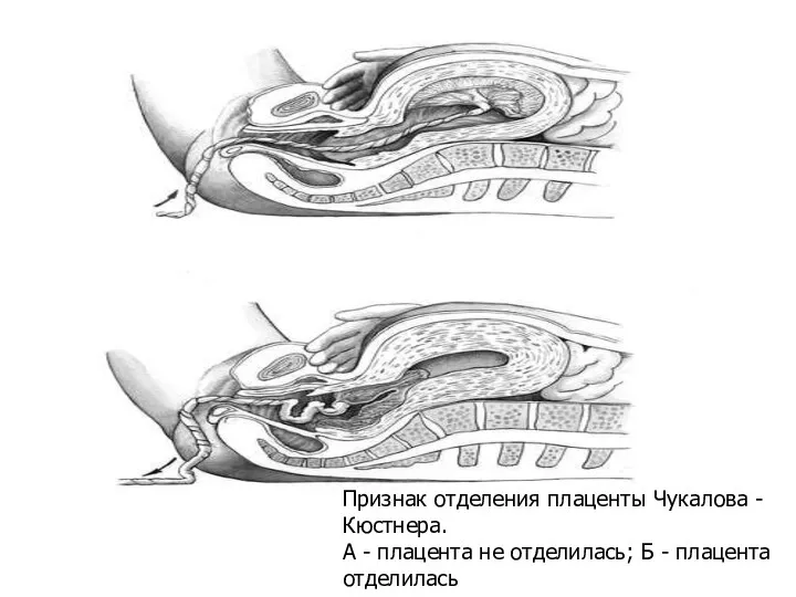 Признак отделения плаценты Чукалова - Кюстнера. А - плацента не отделилась; Б - плацента отделилась