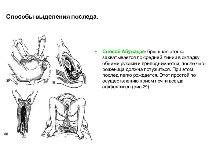 Способы выделения последа. Способ Абуладзе: брюшная стенка захватывается по средней