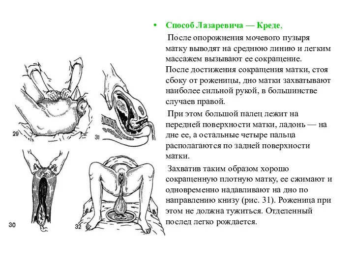 . Способ Лазаревича — Креде, После опорожнения мочевого пузыря матку