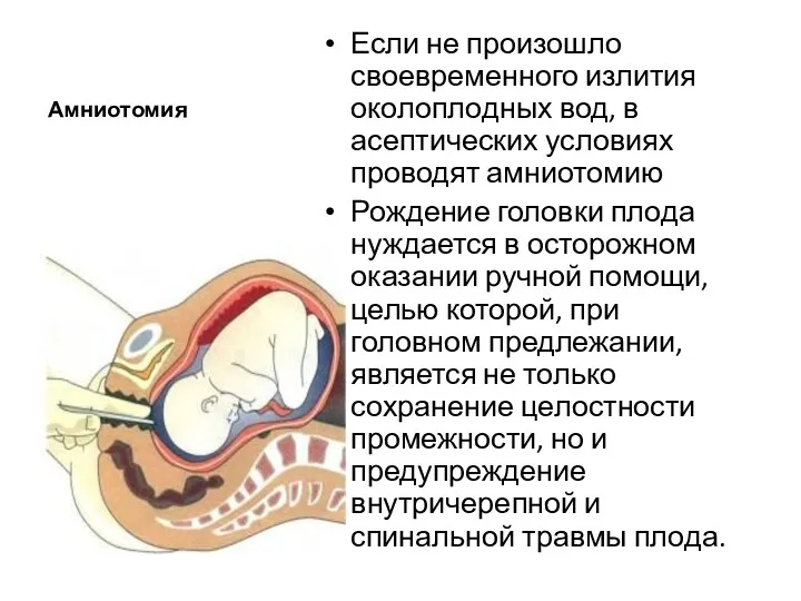 Амниотомия Если не произошло своевременного излития околоплодных вод, в асептических