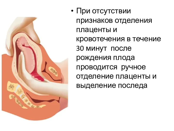 При отсутствии признаков отделения плаценты и кровотечения в течение 30