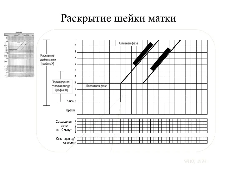 Раскрытие шейки матки Линия бдительности Линия действия WHO, 1994