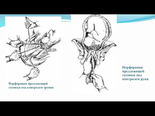Перфорация предлежащей головки под контролем зрения Перфорация предлежащей головки под контролем руки