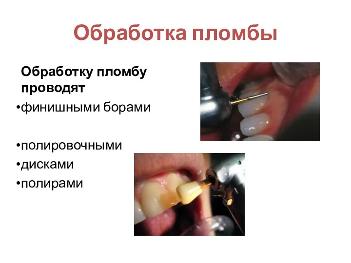 Обработка пломбы Обработку пломбу проводят финишными борами полировочными дисками полирами