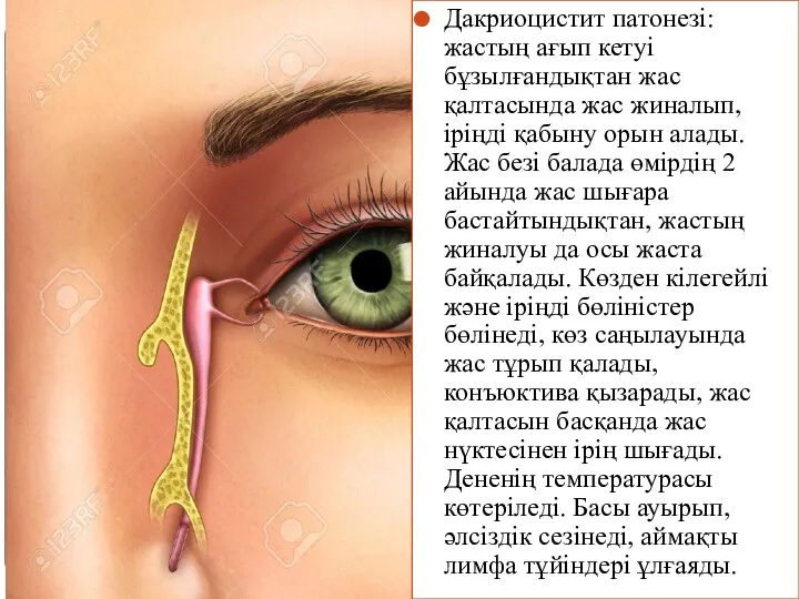 Дакриоцистит патонезі: жастың ағып кетуі бұзылғандықтан жас қалтасында жас жиналып,