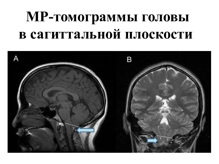 МР-томограммы головы в сагиттальной плоскости