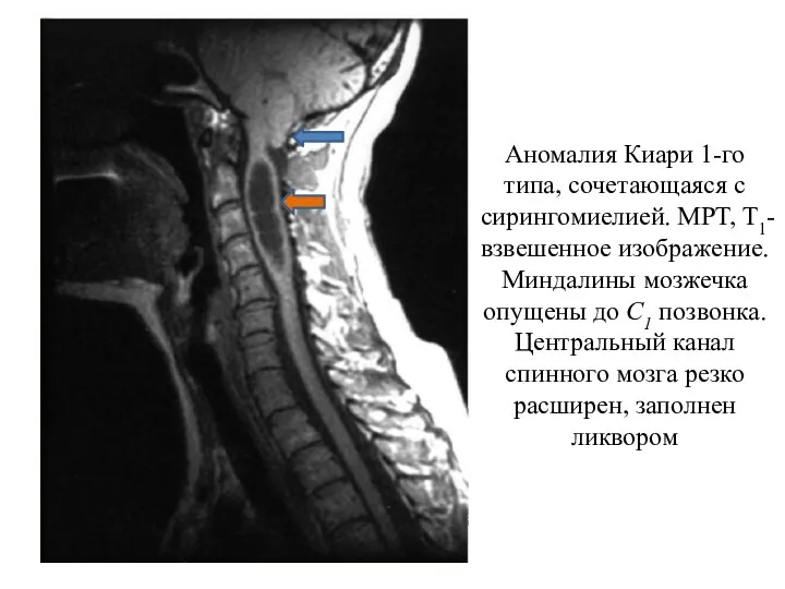 Аномалия Киари 1-го типа, сочетающаяся с сирингомиелией. МРТ, Т1-взвешенное изображение. Миндалины мозжечка опущены