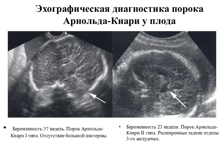 Эхографическая диагностика порока Арнольда-Киари у плода Беременность 37 недель. Порок Арнольда-Киари I типа.