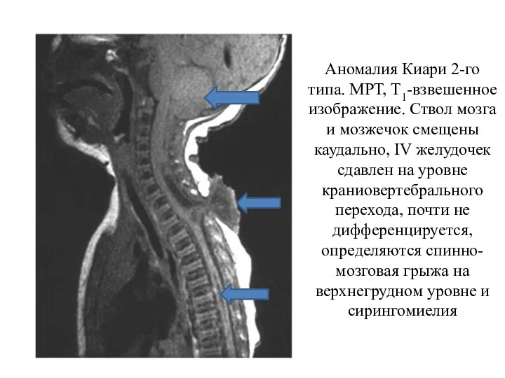 Аномалия Киари 2-го типа. МРТ, Т1-взвешенное изображение. Ствол мозга и мозжечок смещены каудально,