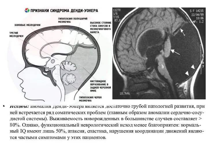 Исходы: аномалия Денди-Уокера является достаточно грубой патологией развития, при ней встречается ряд соматических