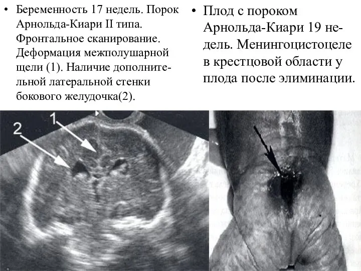 Беременность 17 недель. Порок Арнольда-Киари II типа. Фронтальное сканирование. Деформация межполушарной щели (1).