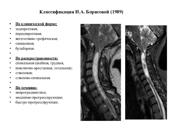 Классификация Н.А. Борисовой (1989) По клинической форме: заднероговая; переднероговая; вегетативно-трофическая; смешанная; бульбарная. По