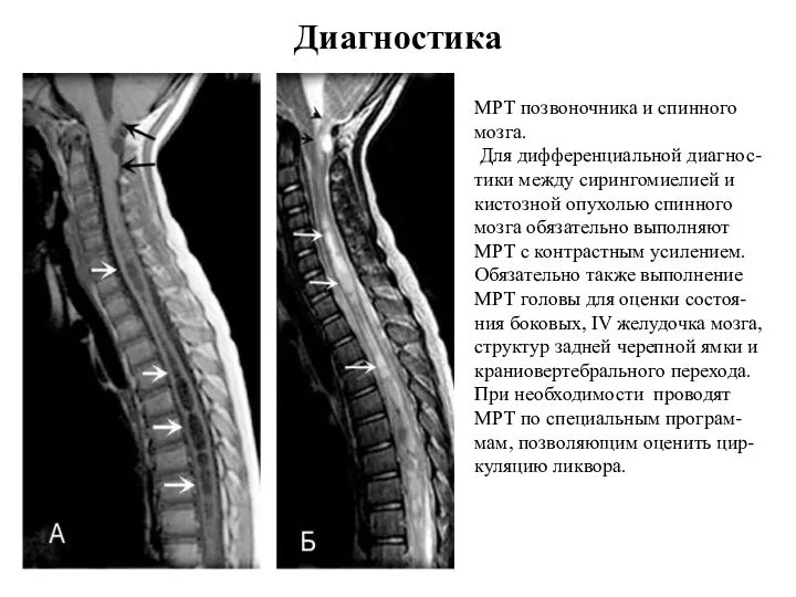 Диагностика МРТ позвоночника и спинного мозга. Для дифференциальной диагнос-тики между сирингомиелией и кистозной