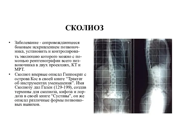 СКОЛИОЗ Заболевание - сопровождающееся боковым искривлением позвоноч-ника, установить и контролирова- ть эволюцию которого