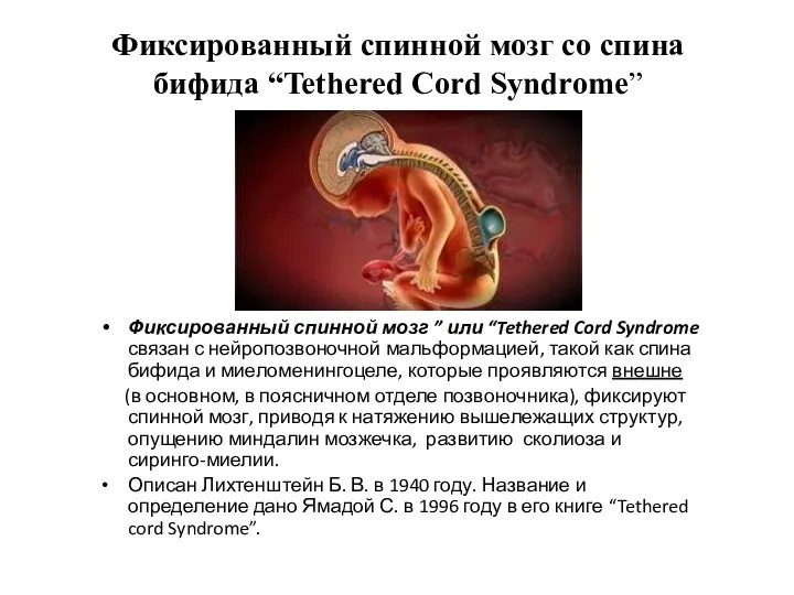 Фиксированный спинной мозг со спина бифида “Tethered Cord Syndrome” Фиксированный спинной мозг ”