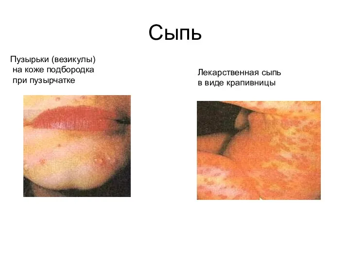 Сыпь Лекарственная сыпь в виде крапивницы Пузырьки (везикулы) на коже подбородка при пузырчатке