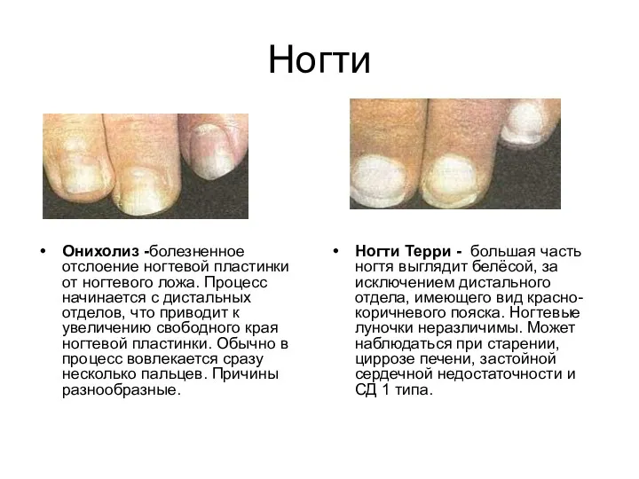 Ногти Онихолиз -болезненное отслоение ногтевой пластинки от ногтевого ложа. Процесс