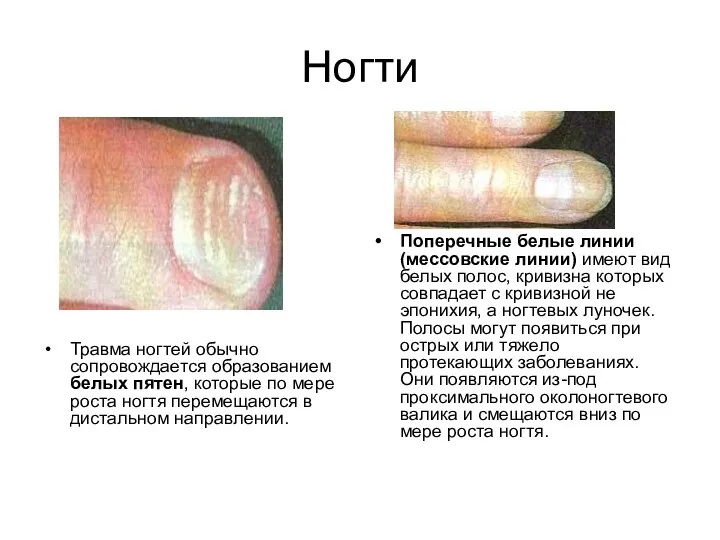Ногти Травма ногтей обычно сопровождается образованием белых пятен, которые по
