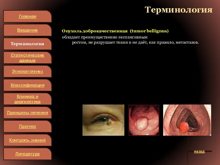 Терминология Опухоль доброкачественная (tumor bellignus) обладает преимущественно экспансивным ростом, не