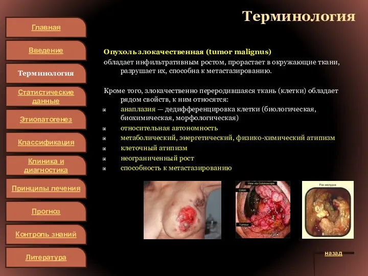Терминология Опухоль злокачественная (tumor malignus) обладает инфильтративным ростом, прорастает в