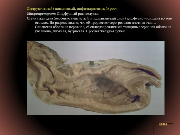 Деструктивный (инвазивный, инфильтративный) рост Макропрепарат: Диффузный рак желудка Стенка желудка