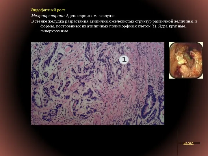 Эндофитный рост Микропрепарат: Аденокарцинома желудка В стенке желудка разрастания атипичных