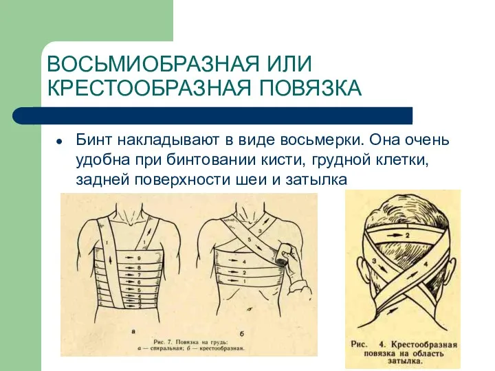 ВОСЬМИОБРАЗНАЯ ИЛИ КРЕСТООБРАЗНАЯ ПОВЯЗКА Бинт накладывают в виде восьмерки. Она