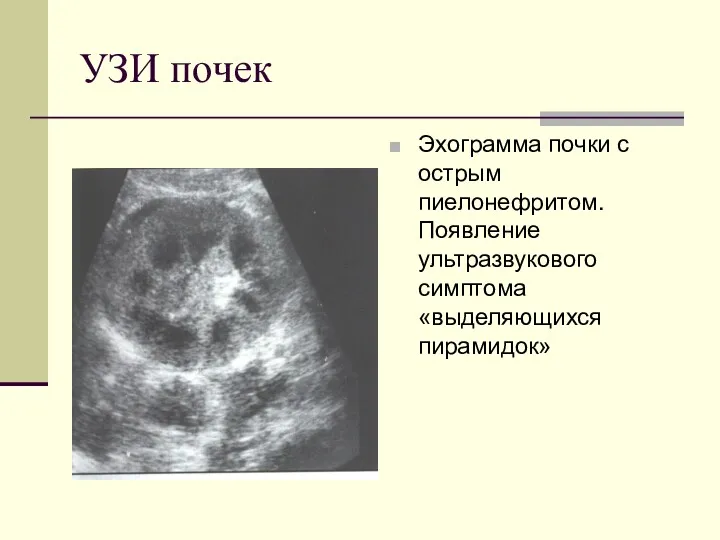 УЗИ почек Эхограмма почки с острым пиелонефритом. Появление ультразвукового симптома «выделяющихся пирамидок»