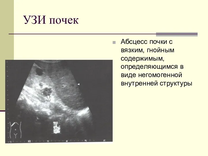 УЗИ почек Абсцесс почки с вязким, гнойным содержимым, определяющимся в виде негомогенной внутренней структуры