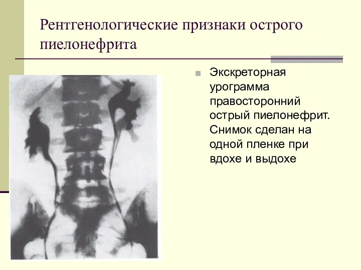 Рентгенологические признаки острого пиелонефрита Экскреторная урограмма правосторонний острый пиелонефрит. Снимок