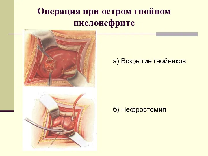 Операция при остром гнойном пиелонефрите а) Вскрытие гнойников б) Нефростомия