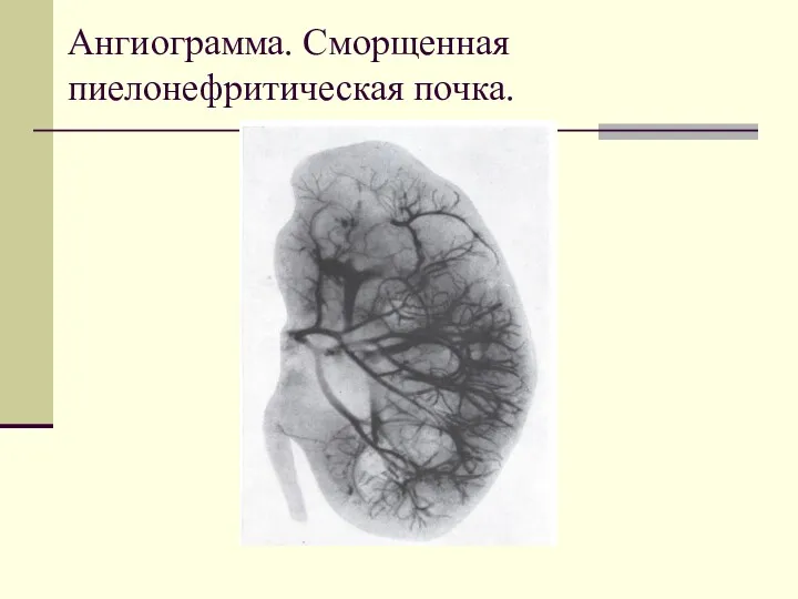 Ангиограмма. Сморщенная пиелонефритическая почка.