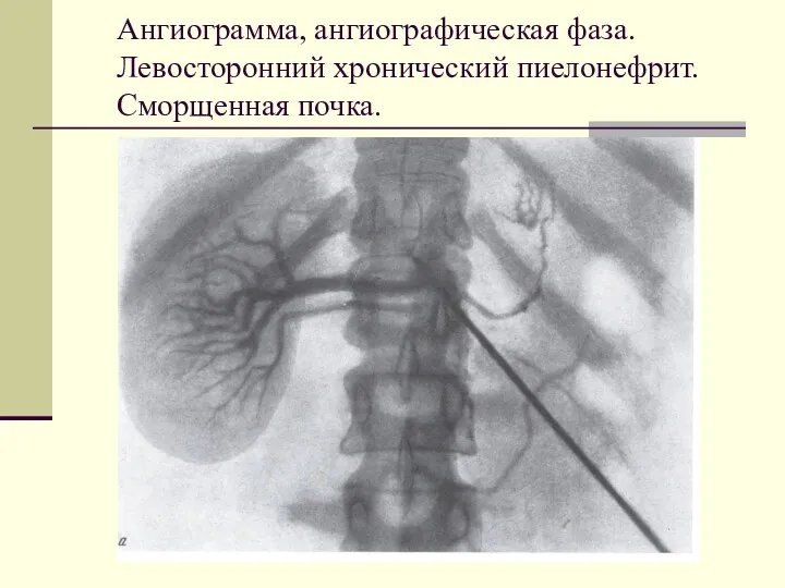 Ангиограмма, ангиографическая фаза. Левосторонний хронический пиелонефрит. Сморщенная почка.