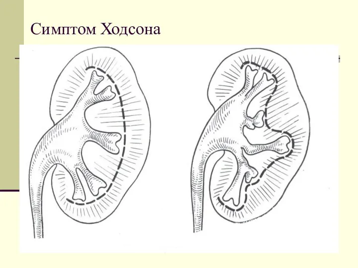 Симптом Ходсона